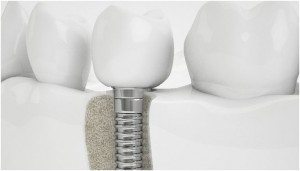 implantes boli 300x171 - Clínica dental los Boliches