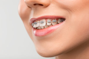 1047 300x200 - Tipos de ortodoncia ¿Cuál es el mejor?